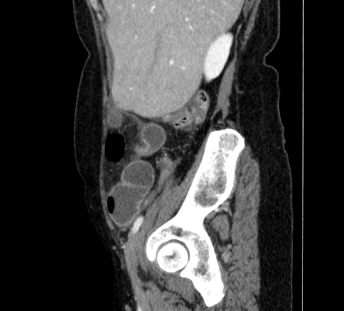 Closed loop small bowel obstruction (Radiopaedia 71211-81508 C 19).jpg