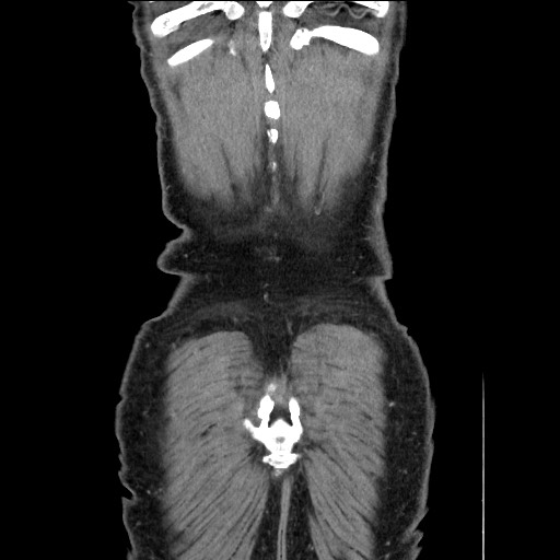 File:Closed loop small bowel obstruction - omental adhesion causing "internal hernia" (Radiopaedia 85129-100682 B 120).jpg