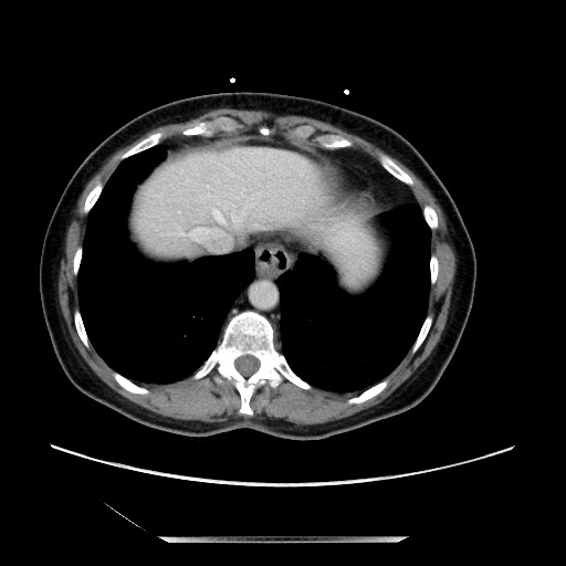 File:Closed loop small bowel obstruction due to adhesive bands - early and late images (Radiopaedia 83830-99014 Axial 159).jpg