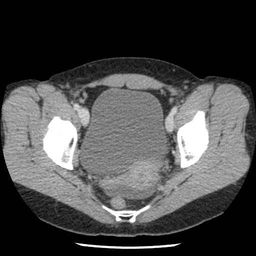 File:Closed loop small bowel obstruction due to trans-omental herniation (Radiopaedia 35593-37109 A 77).jpg