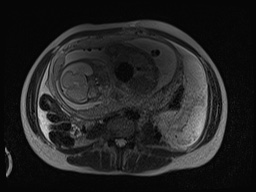 File:Closed loop small bowel obstruction in pregnancy (MRI) (Radiopaedia 87637-104031 D 6).jpg