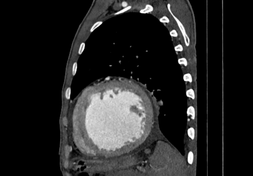 Coarctation of aorta with aortic valve stenosis (Radiopaedia 70463-80574 B 163).jpg