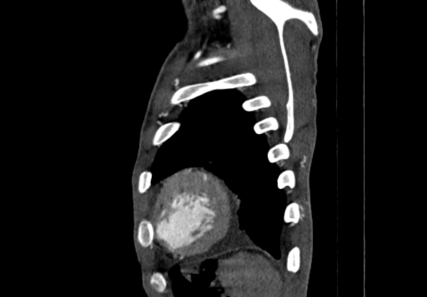 Coarctation of aorta with aortic valve stenosis (Radiopaedia 70463-80574 B 219).jpg