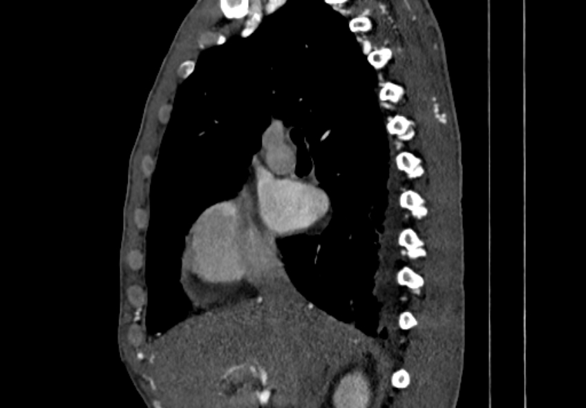 Coarctation of aorta with aortic valve stenosis (Radiopaedia 70463-80574 B 7).jpg
