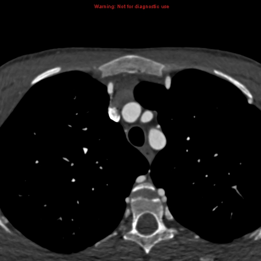 File:Coarctation of the aorta (Radiopaedia 12461-12697 A 22).jpg