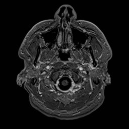 File:Cochlear incomplete partition type III associated with hypothalamic hamartoma (Radiopaedia 88756-105498 Axial T1 C+ 27).jpg