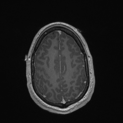 File:Colloid cyst (Radiopaedia 44510-48181 Axial T1 C+ 146).png