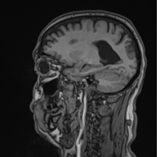 File:Colloid cyst of the third ventricle (Radiopaedia 86571-102662 Sagittal T1 26).png