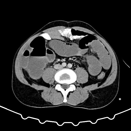 Colocolic intussusception due to large lipoma (Radiopaedia 68773-78482 A 115).jpg
