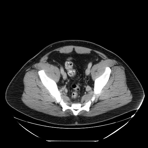File:Colocolic intussusception due to lipoma (Radiopaedia 73712-84508 Axial 99).jpg