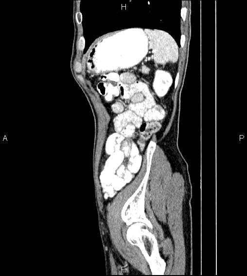 File:Colon adenocarcinoma - hepatic flexure (Radiopaedia 85635-101395 D 75).jpg