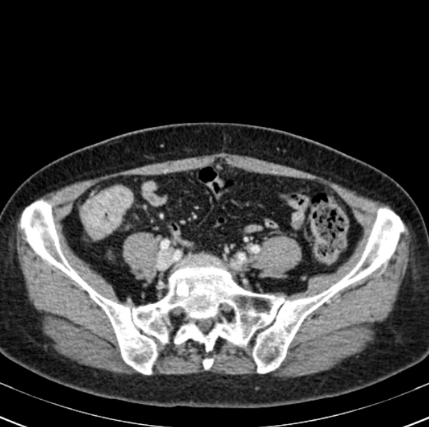 Colon carcinoma with hepatic metastases (Radiopaedia 29477-29961 A 82).jpg