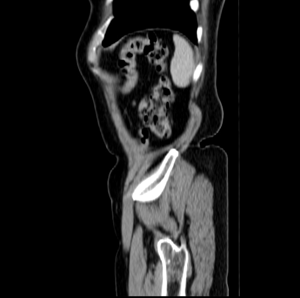 Colon carcinoma with hepatic metastases (Radiopaedia 29477-29961 C 51).jpg