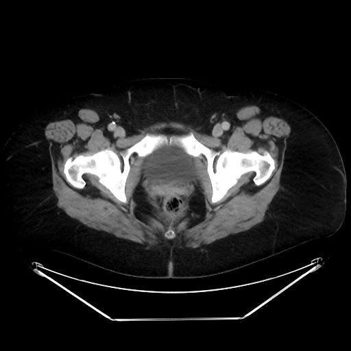 File:Colonic intussusception due to adenocarcinoma (Radiopaedia 86828-102987 Axial 118).jpg