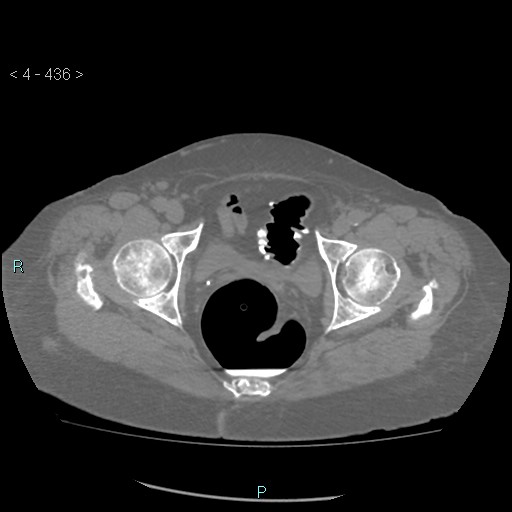 Colonic lipomas (Radiopaedia 49137-54244 Axial bone window 194).jpg