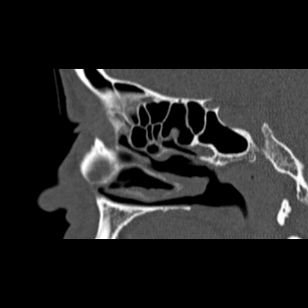 Nasal septal perforation (Radiopaedia 25030-25289 Sagittal bone window 43).jpg