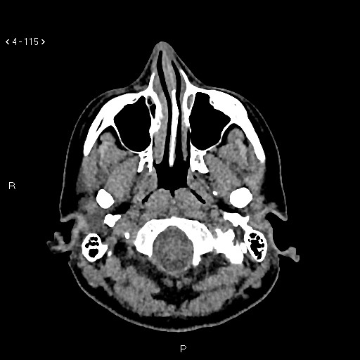 Nasolabial cyst (Radiopaedia 75125-86194 Axial non-contrast 77).jpg