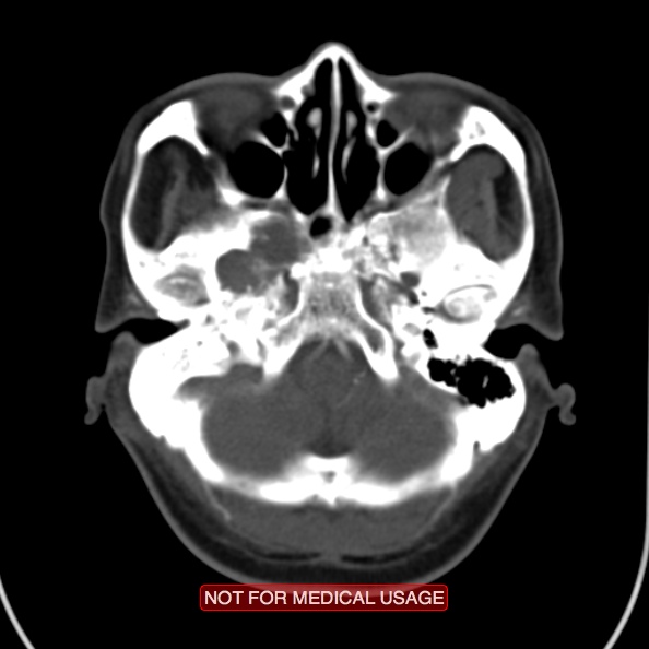 File:Nasopharyngeal carcinoma recurrence - skull base destruction (Radiopaedia 29107-29491 A 7).jpg