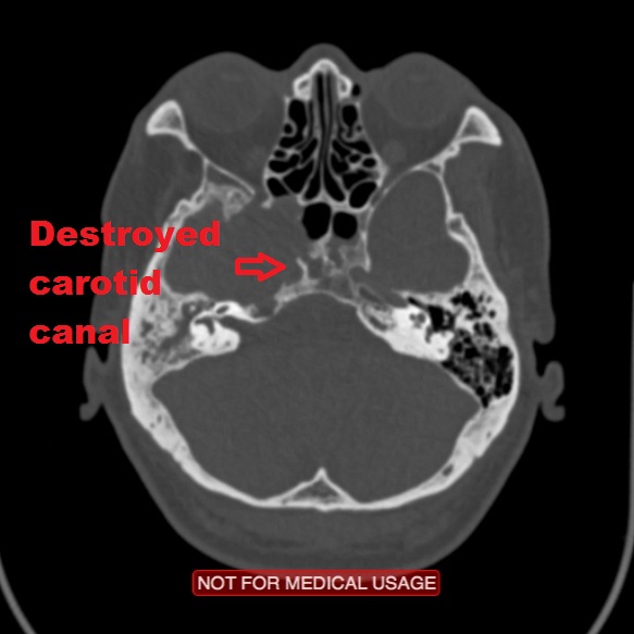 File:Nasopharyngeal carcinoma recurrence - skull base destruction (Radiopaedia 29107-30461 skull base 1).jpg