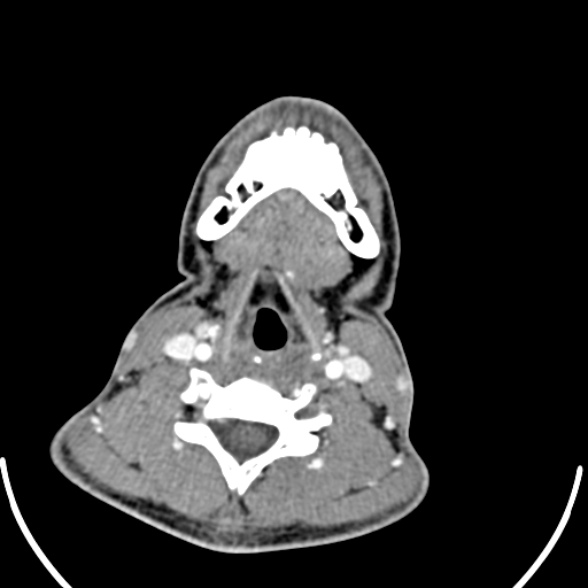 Nasopharyngeal carcinoma with skull base invasion (Radiopaedia 53415-59705 A 142).jpg