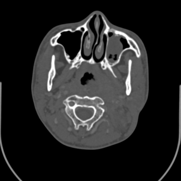 Nasopharyngeal carcinoma with skull base invasion (Radiopaedia 53415-59705 Axial bone window 65).jpg