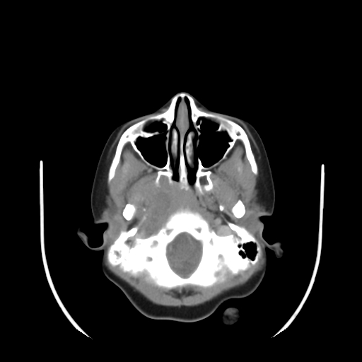 File:Nasopharyngeal rhabdomyosarcoma (Radiopaedia 23417-23491 Axial non-contrast 3).jpg