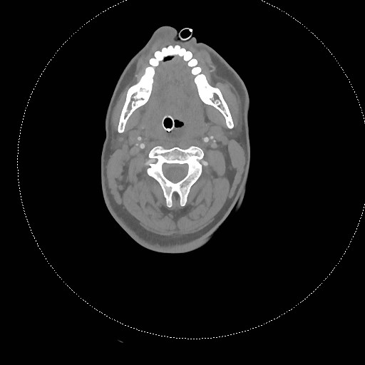 Neck CT angiogram (intraosseous vascular access) (Radiopaedia 55481-61945 B 211).jpg