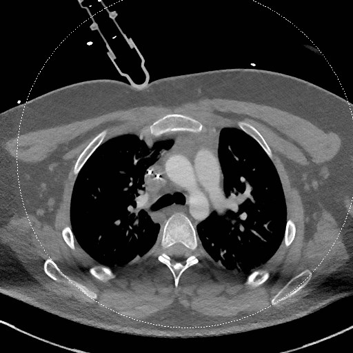 File:Neck CT angiogram (intraosseous vascular access) (Radiopaedia 55481-61945 B 45).jpg