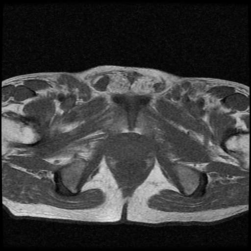 File:Necrotizing epididymo-orchitis with intra-testicular abscess (Radiopaedia 29397-29860 Axial T1 6).jpg
