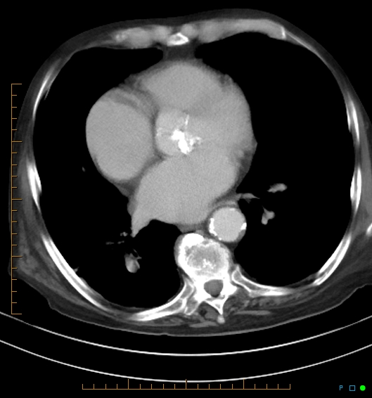 Necrotzing fasciitis due to a perforated adenocarcinoma of the splenic flexure (Radiopaedia 46930-51455 A 8).jpg