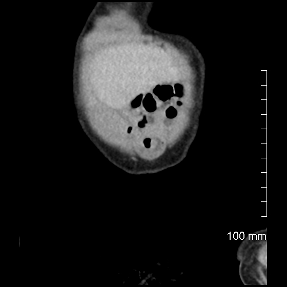 File:Neonatal neuroblastoma (Radiopaedia 56651-63438 Coronal non-contrast 6).jpg
