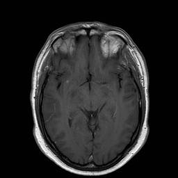 File:Neuro-Behcet's disease (Radiopaedia 21557-21505 Axial T1 C+ 10).jpg