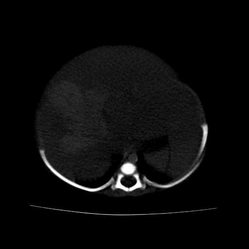 File:Neuroblastoma (Radiopaedia 20876-20799 Axial bone window 6).jpg
