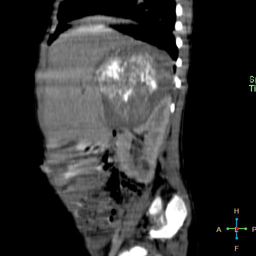 File:Neuroblastoma (Radiopaedia 24751-25016 C 21).jpg