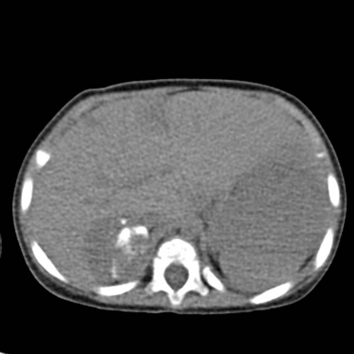 Neuroblastoma with skull metastases (Radiopaedia 30326-30960 Axial non-contrast 13).jpg
