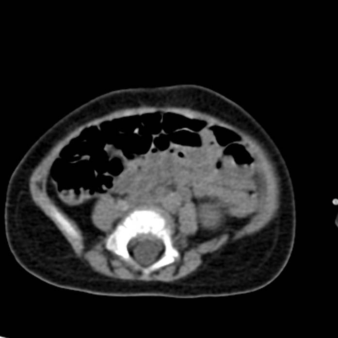 Neuroblastoma with skull metastases (Radiopaedia 30326-30960 Axial non-contrast 40).jpg