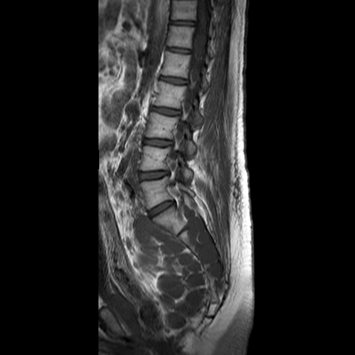 File:Neurofibromatosis type 1- extensive spinal involvement and Christmas tree sign (Radiopaedia 60610-68332 Sagittal T1 7).jpg