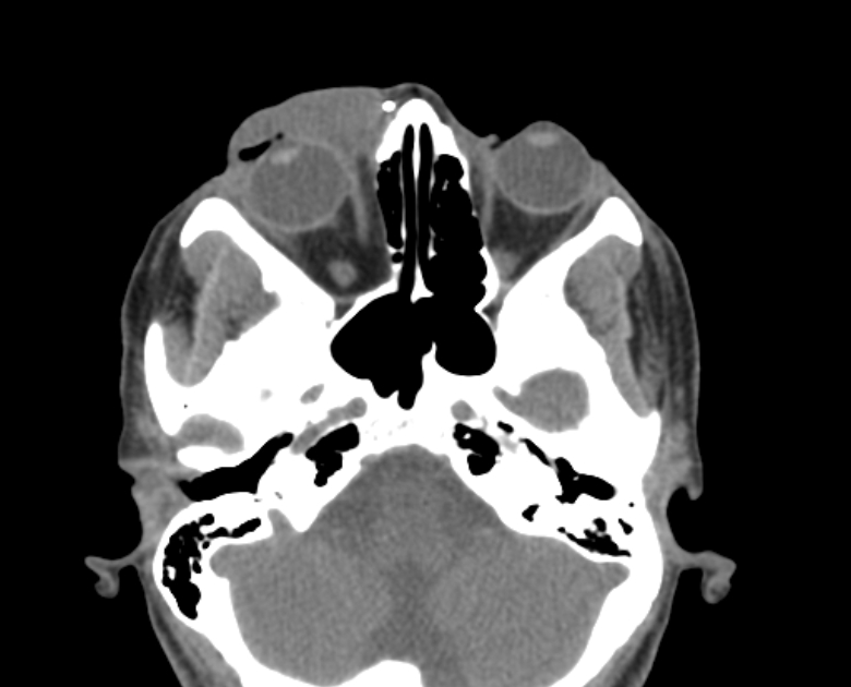 Neurofibromatosis type 1- orbital manifestations (Radiopaedia 49391-54511 Axial non-contrast 44).jpg