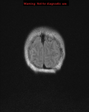 File:Neurofibromatosis type 1 with optic nerve glioma (Radiopaedia 16288-15965 Coronal FLAIR 1).jpg