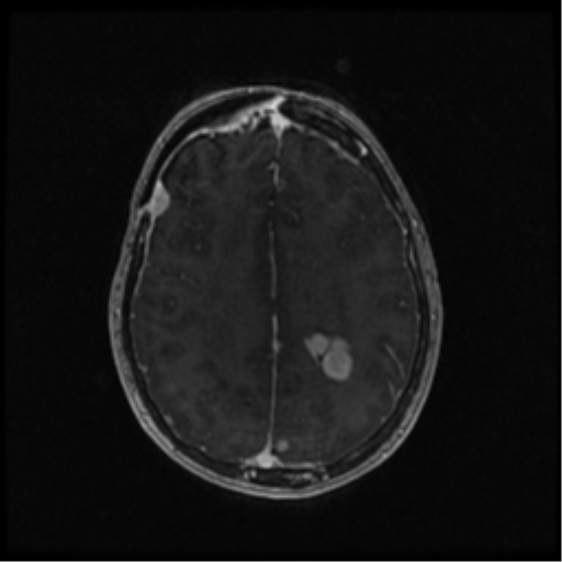 Neurofibromatosis type 2 (Radiopaedia 45229-49244 Axial T1 C+ 80).png