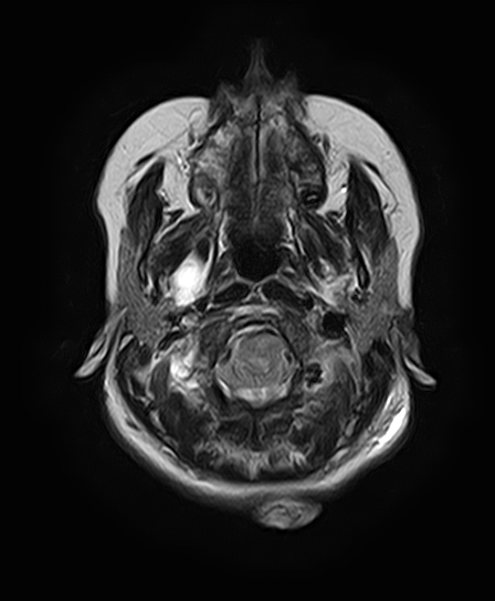 File:Neurofibromatosis type 2 (Radiopaedia 66211-75401 Axial T2 7).jpg