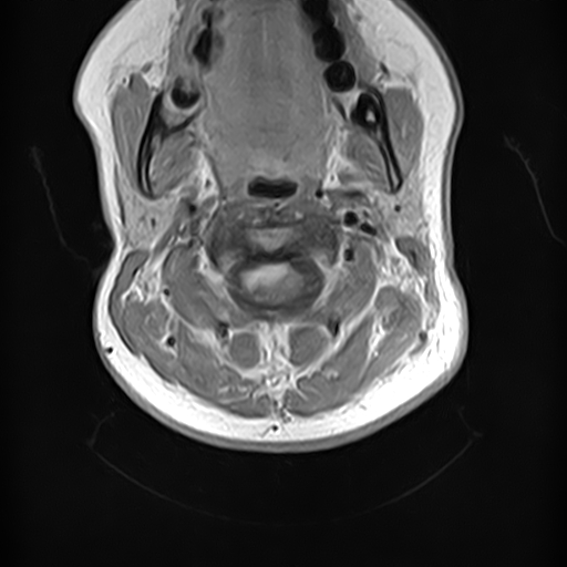 File:Neurofibromatosis type 2 (Radiopaedia 66211-75403 Axial T1 C+ 5).jpg