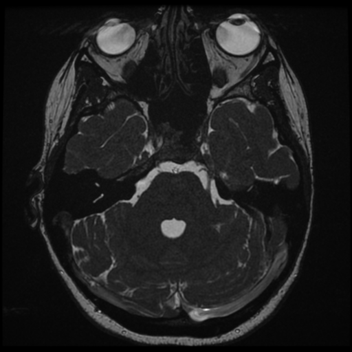 File:Neurofibromatosis type 2 - bilateral acoustic neuromata (Radiopaedia 40060-42566 Axial FIESTA 50).png