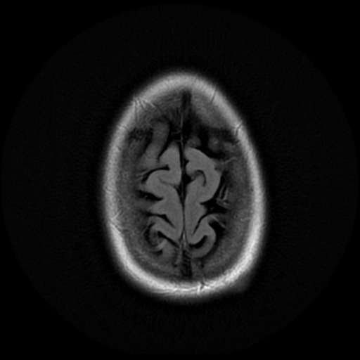 File:Neurofibromatosis type 2 - bilateral acoustic neuromata (Radiopaedia 40060-42566 Axial FLAIR 20).png