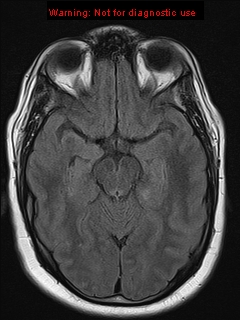 File:Neuroglial cyst (Radiopaedia 10713-11184 Axial FLAIR 14).jpg