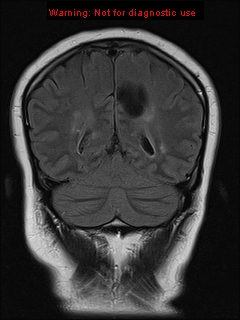 File:Neuroglial cyst (Radiopaedia 10713-11184 Coronal FLAIR 8).jpg
