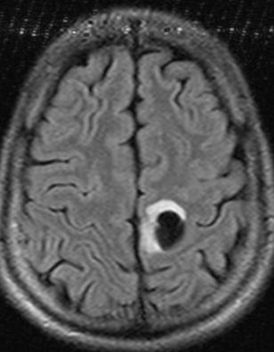 File:Neuroglial cyst (Radiopaedia 10780-11235 Axial FLAIR 1).JPG