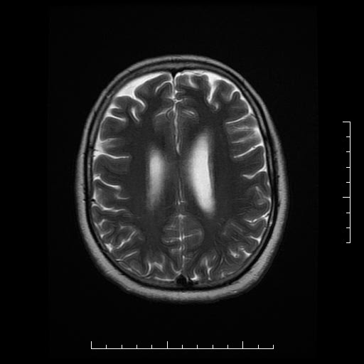 File:Neuroglial cyst of brainstem (Radiopaedia 29134-29526 Axial T2 15).jpg