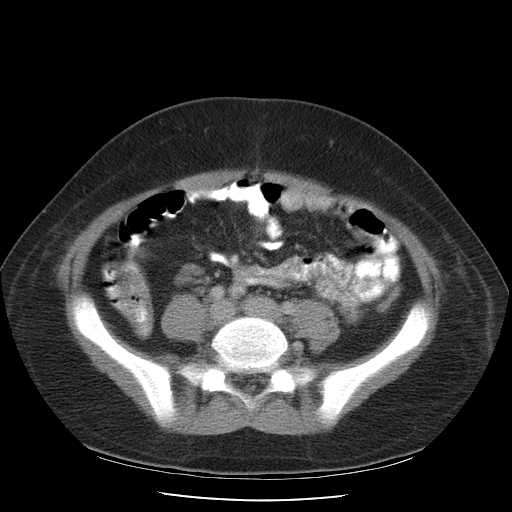 File:Non-Hodgkin lymphoma involving pelvis (Radiopaedia 21281-21197 A 43).jpg