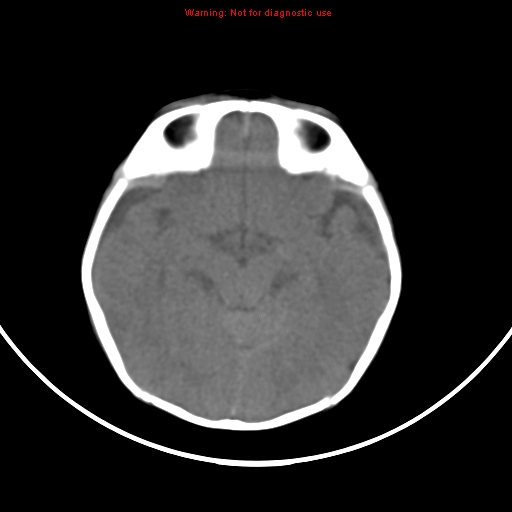 File:Non-accidental injury - bilateral subdural with acute blood (Radiopaedia 10236-10765 Axial non-contrast 9).jpg